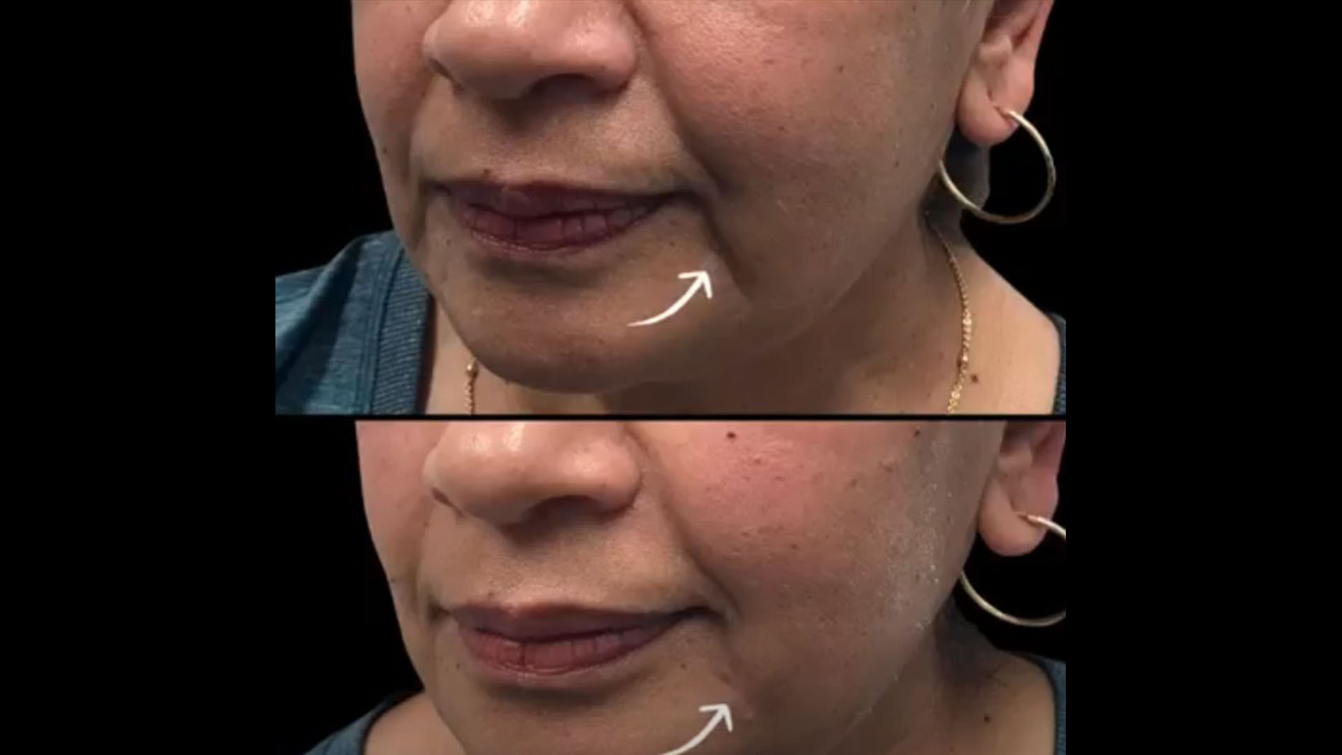 Ultherapy and Fillers: The Perfect Combination for Lifting, Smoothing, and Restoring Youthful Volume