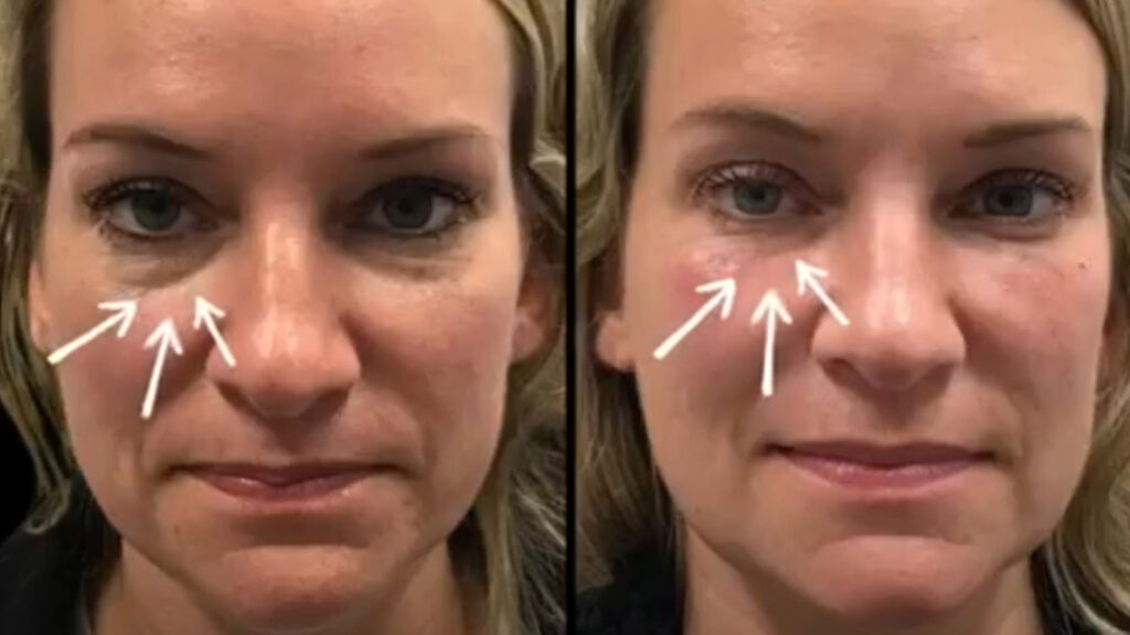 Under Eye Ultherapy and Filler The Ultimate Combination for Natural Youthful Results Cincinnati The Dermatology Laser and Vein Center