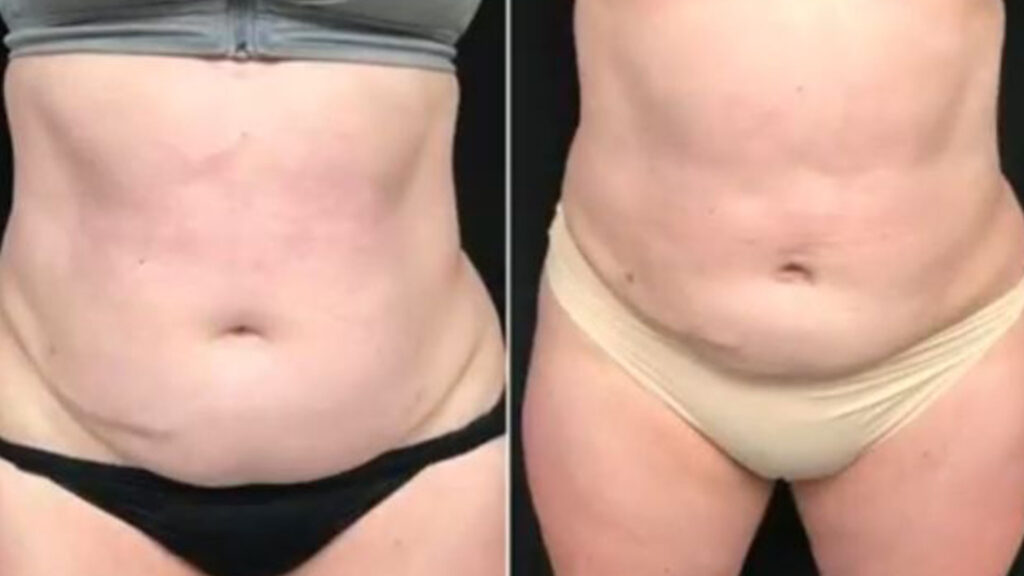 VASER Liposuction Results for Abdomen and Thighs Cincinnati The Dermatology Laser and Vein Center