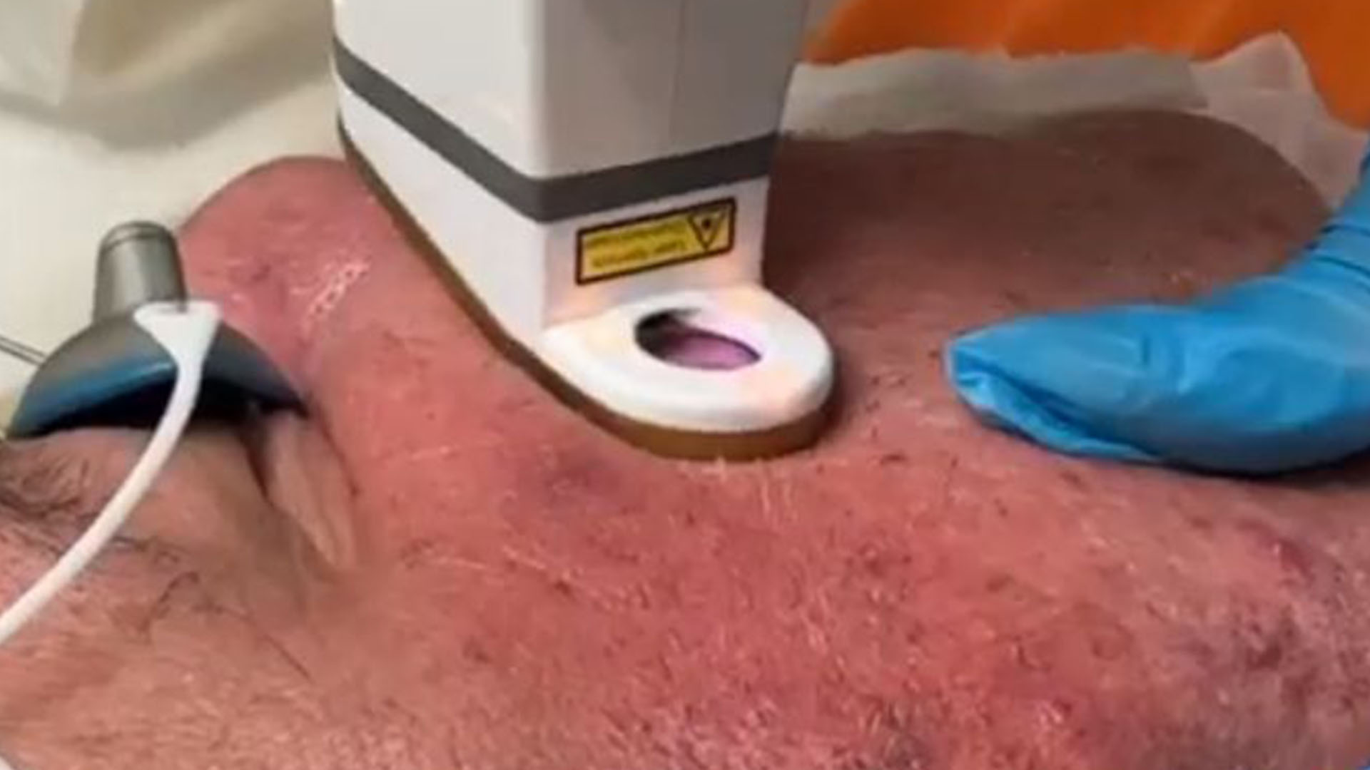 What to Expect with AviClear Acne Treatment