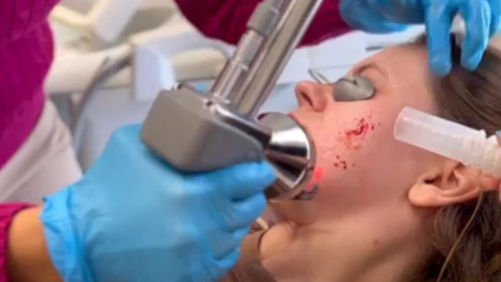 profractional laser acne scar treatment cincinnati the dermatology laser and vein center