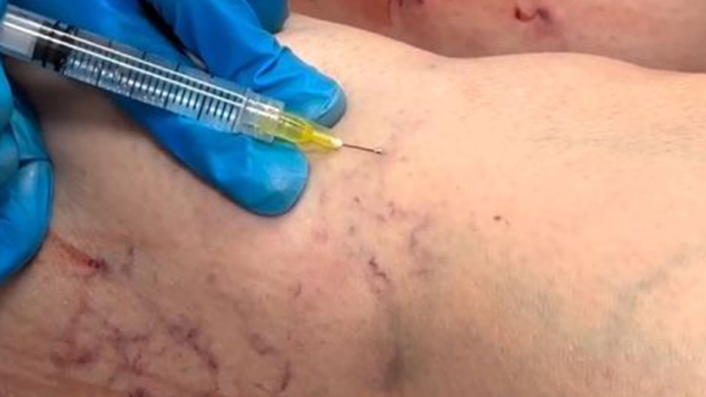 Sclerotherapy Cincinnati, OH | Spider Vein Treatment