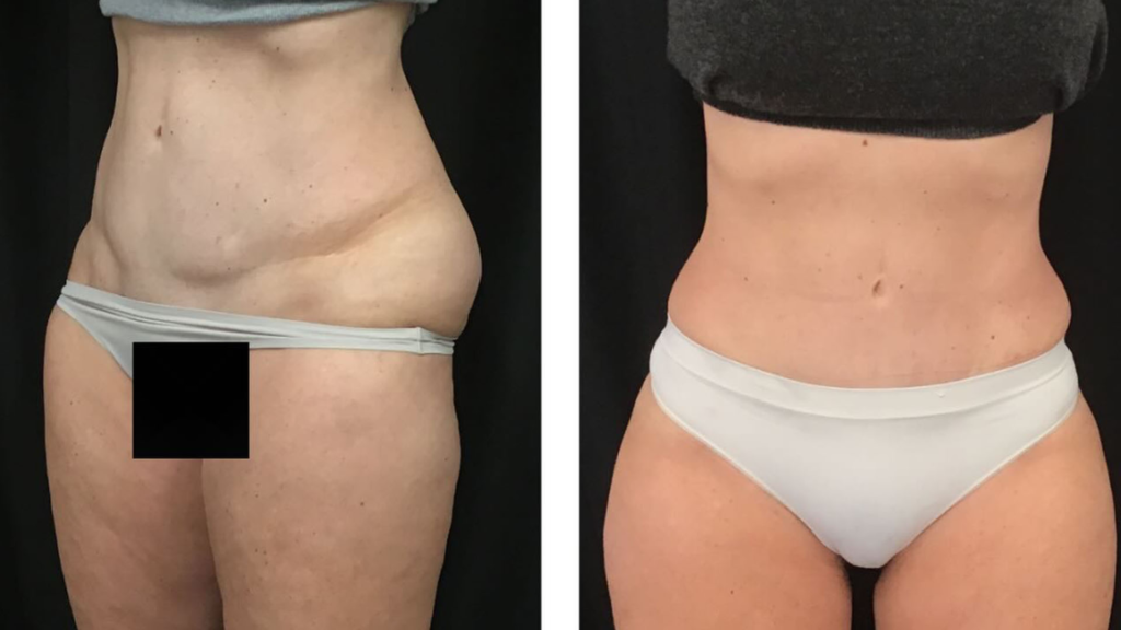 vaser lipo before and after the dermatology laser and vein center cincinnati ohio
