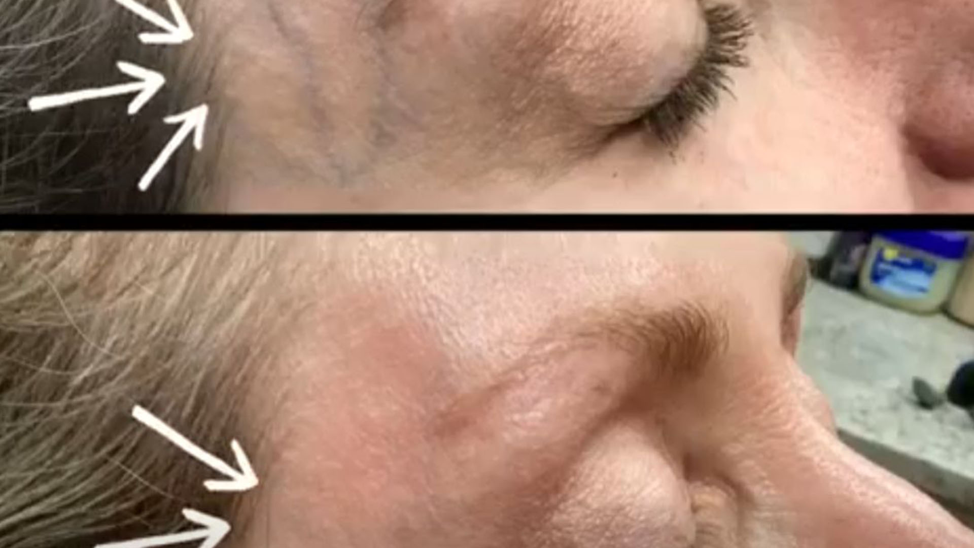Facial Vein Removal with YAG Laser: Stunning Results